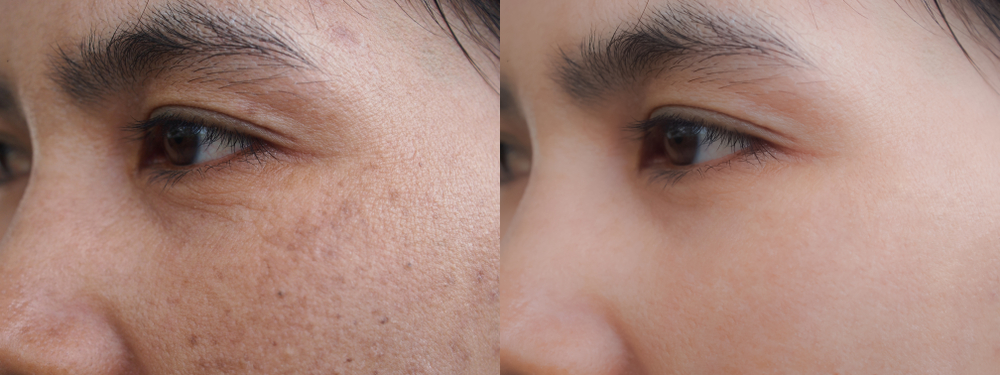 5 Advantages of Using Chemical Peels for Brown Spots