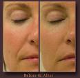 Hydrafacials