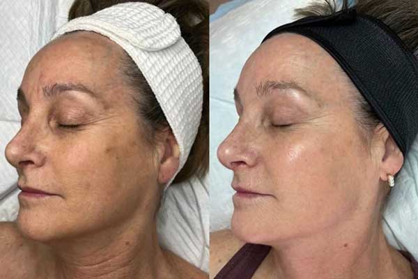 Facial Sculpting and Toning