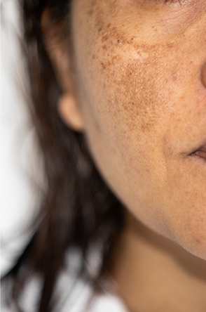 Hyperpigmentation